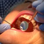 dis minesini onaran yeni jel curuklerin sonu mu geliyor Ct7mPytZ.jpg